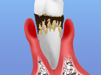 【歯周病とは】